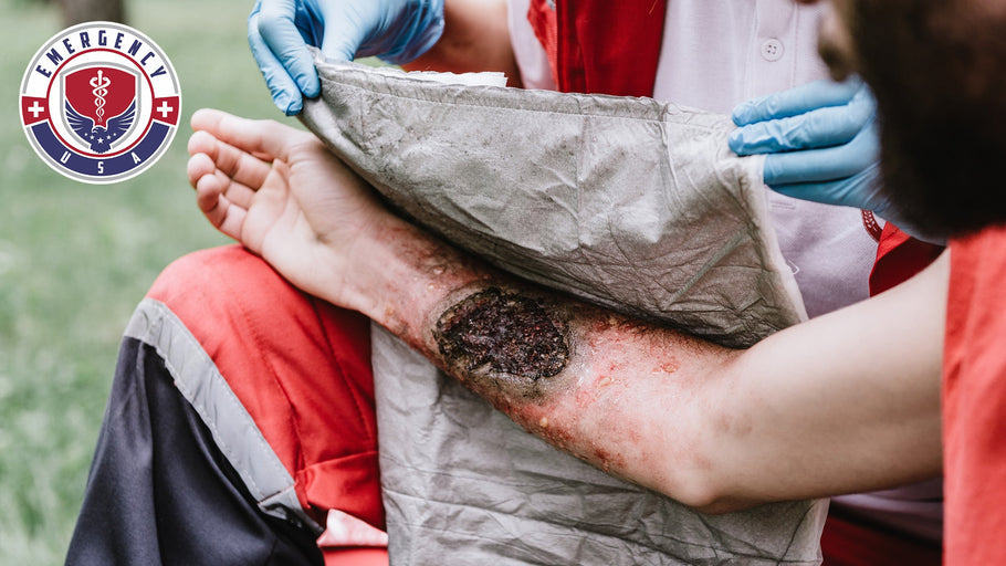The Three Types of Burns and How to Treat Them